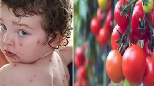 टोमॅटो फ्लूची नेमकी काय आहेत लक्षणं?…जाणून घ्या डॉ. विनायक पाटील यांनी सांगितलेले उपाय…