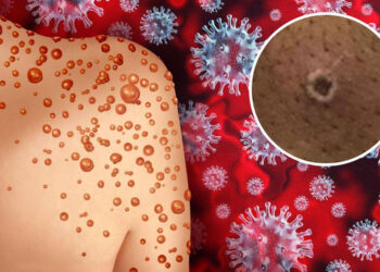 चिंताजनक! देशात नव्या रोगाचा शिरकाव; ही लक्षणे दिसल्यास काळजी घ्या…