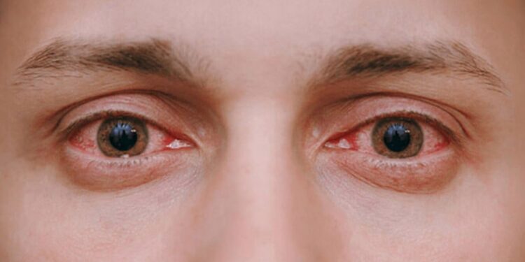 सावधान! रायगड जिल्ह्यात डोळ्यांची साथ…जाणून घ्या लक्षणे