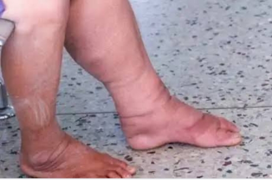 उरण तालुक्यात हत्तीरोगाचे रुग्ण; आरोग्य विभागाचे दुर्लक्ष