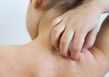 राज्यात गोवरचा प्रादुर्भाव वाढतोय