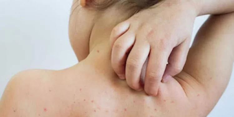 राज्यात गोवरचा प्रादुर्भाव वाढतोय