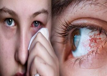 जिल्ह्यात डोळ्यांच्या साथीचा शिरकाव