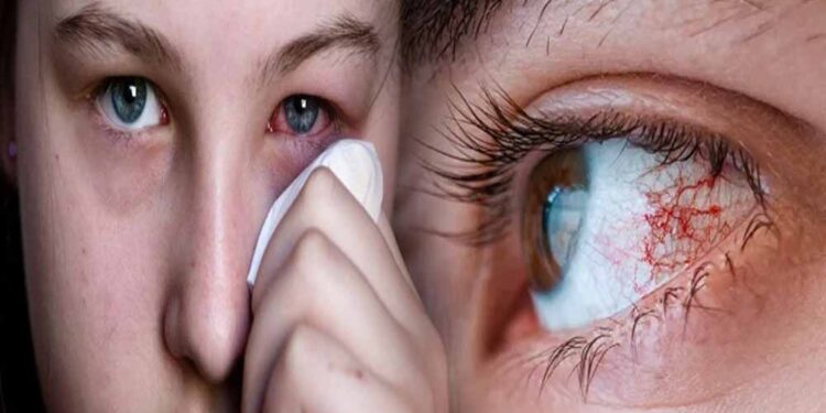 जिल्ह्यात डोळ्यांच्या साथीचा शिरकाव