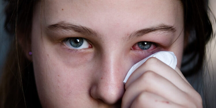 डोळ्यांच्या साथीचा प्रादुर्भाव